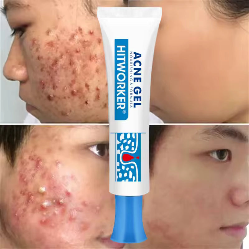 Avenza™ Gel Anti-Acné