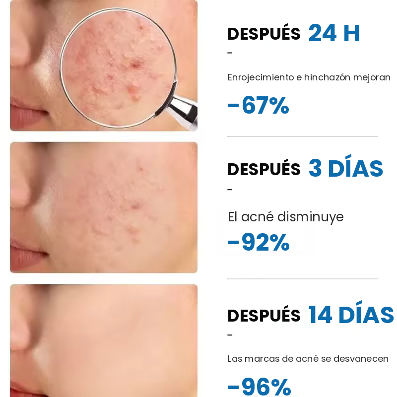 Avenza™ Gel Anti-Acné