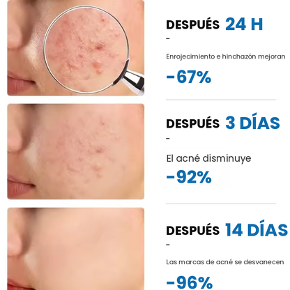 Avenza™ Gel Anti-Acné