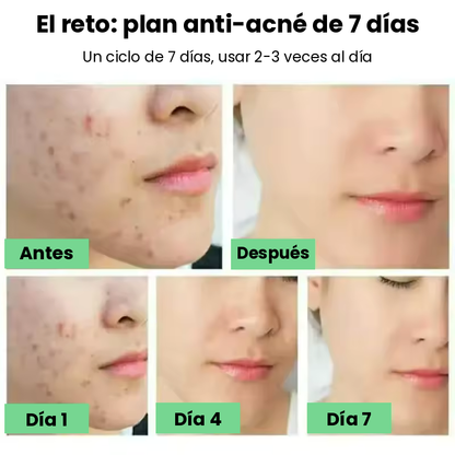 Avenza™ Gel Anti-Acné